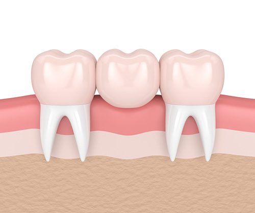 Dental Bridge